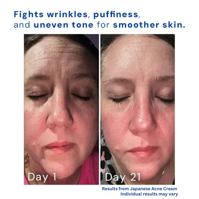 Reskin™ Japanese Acne Cream