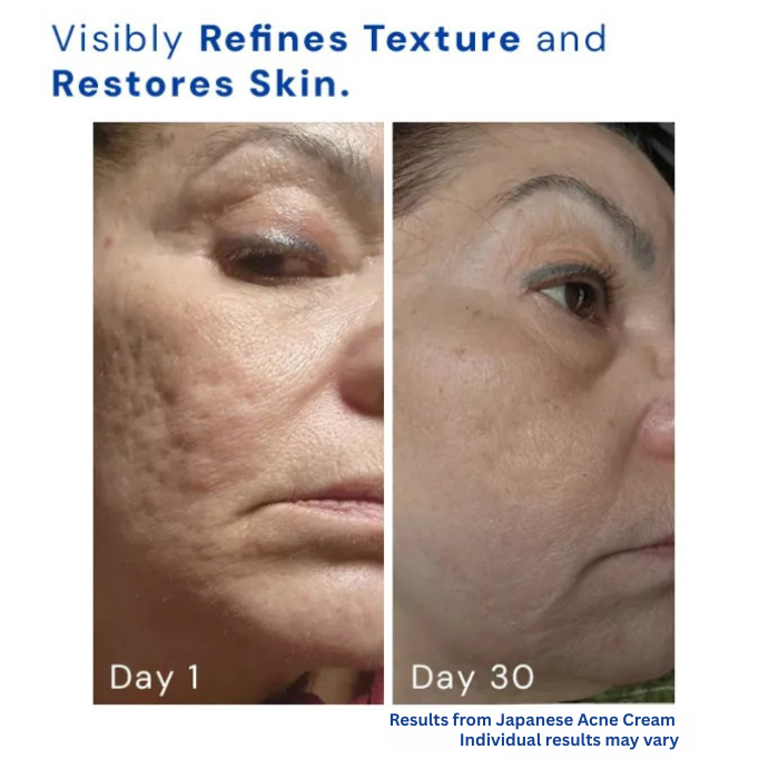 Reskin™ Japanese Acne Cream